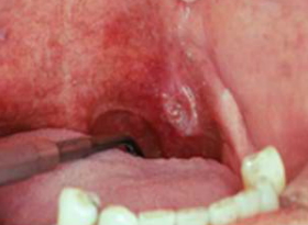 Dấu hiệu sớm của ung thư miệng